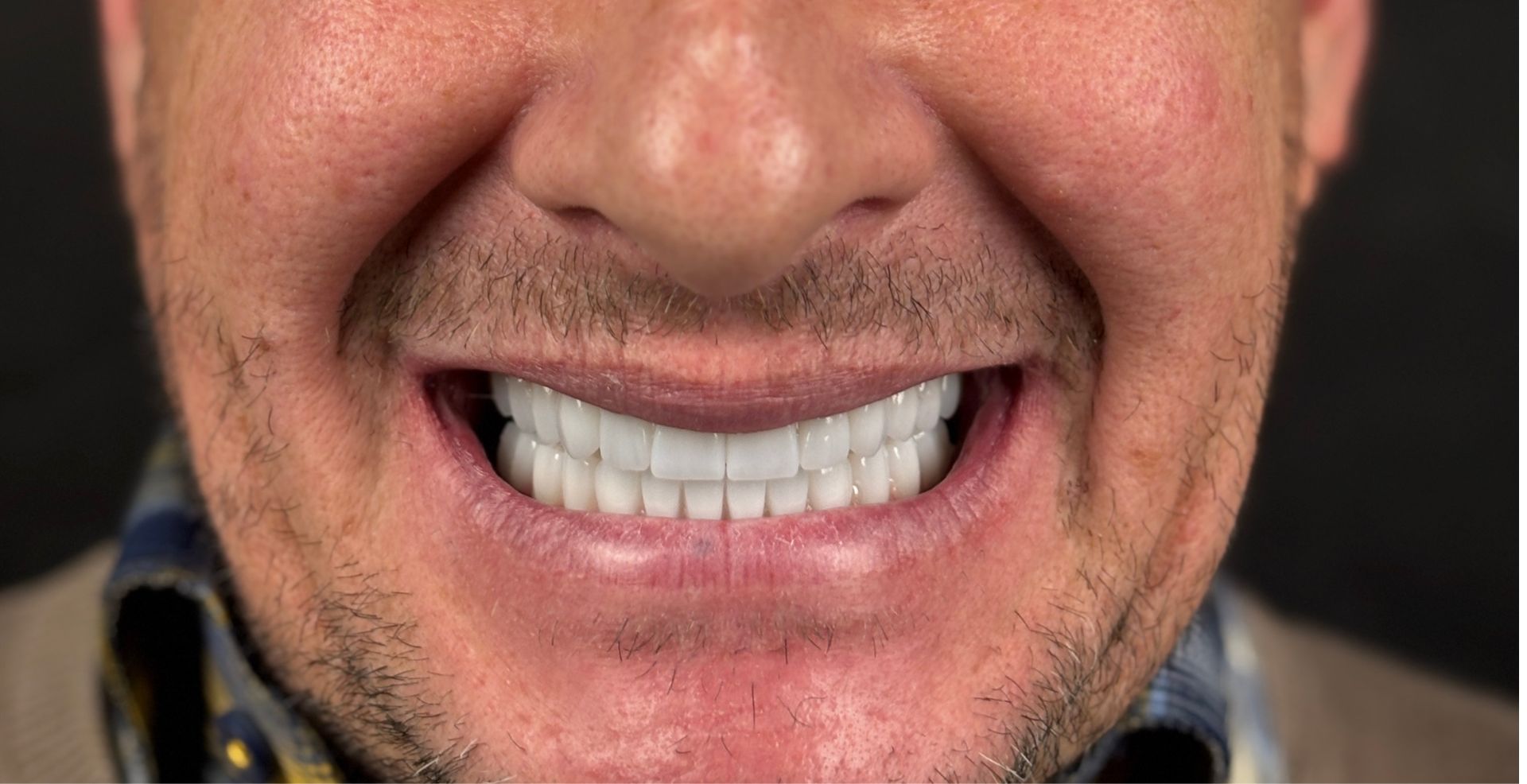 Smile design estetică dentară Anghele Dental Iași, rezultat după tratament