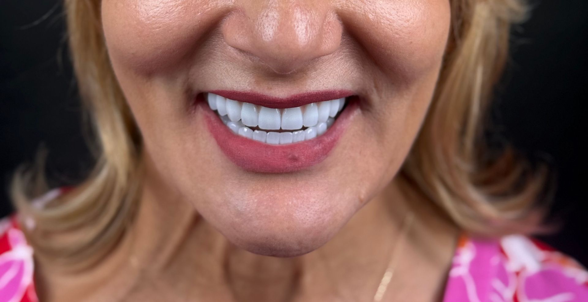 Reabilitare completă multidisciplinară Anghele Dental Iași, rezultat