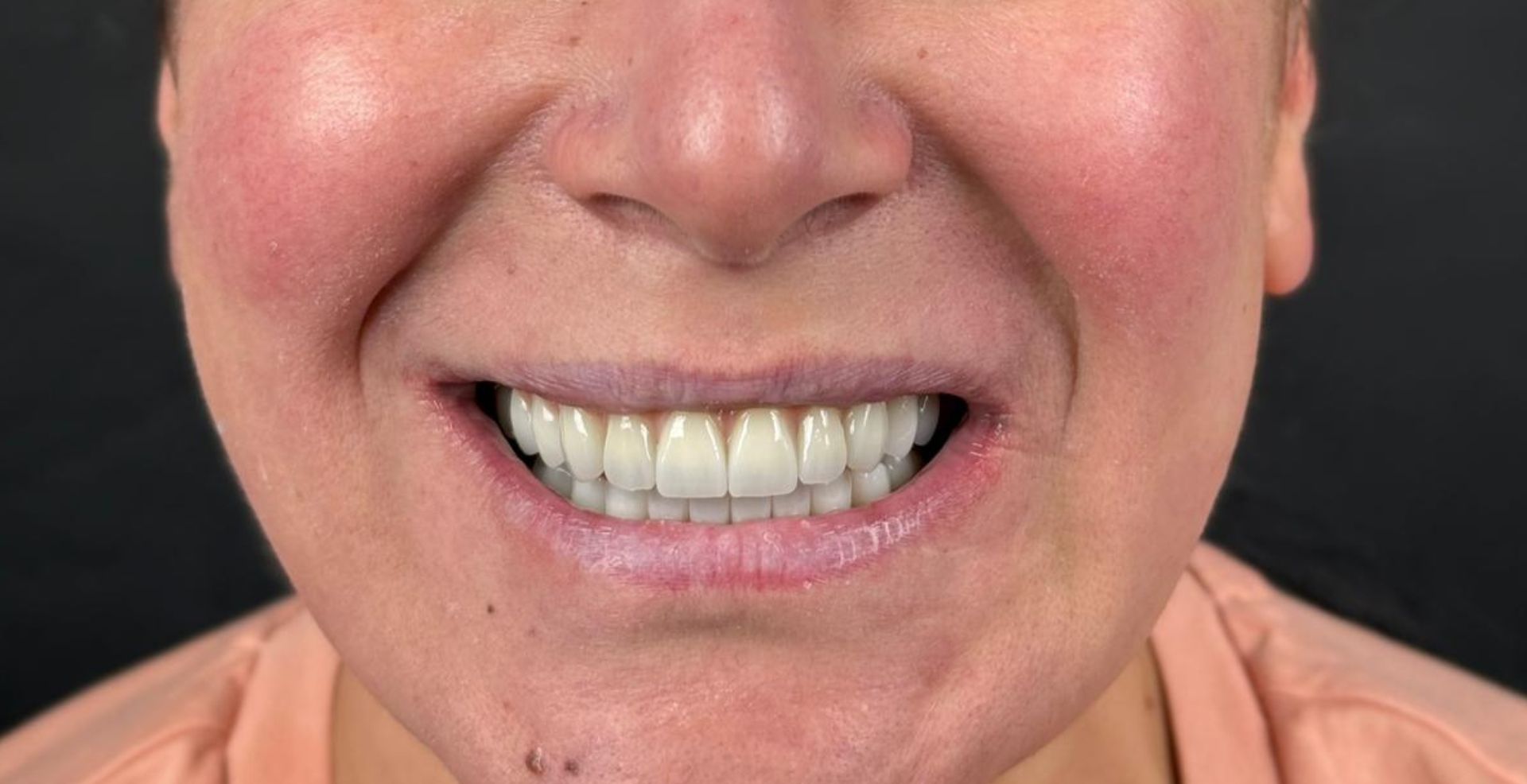 Reabilitare arcadă cu implanturi la Anghele Dental Iași, rezultat după tratament