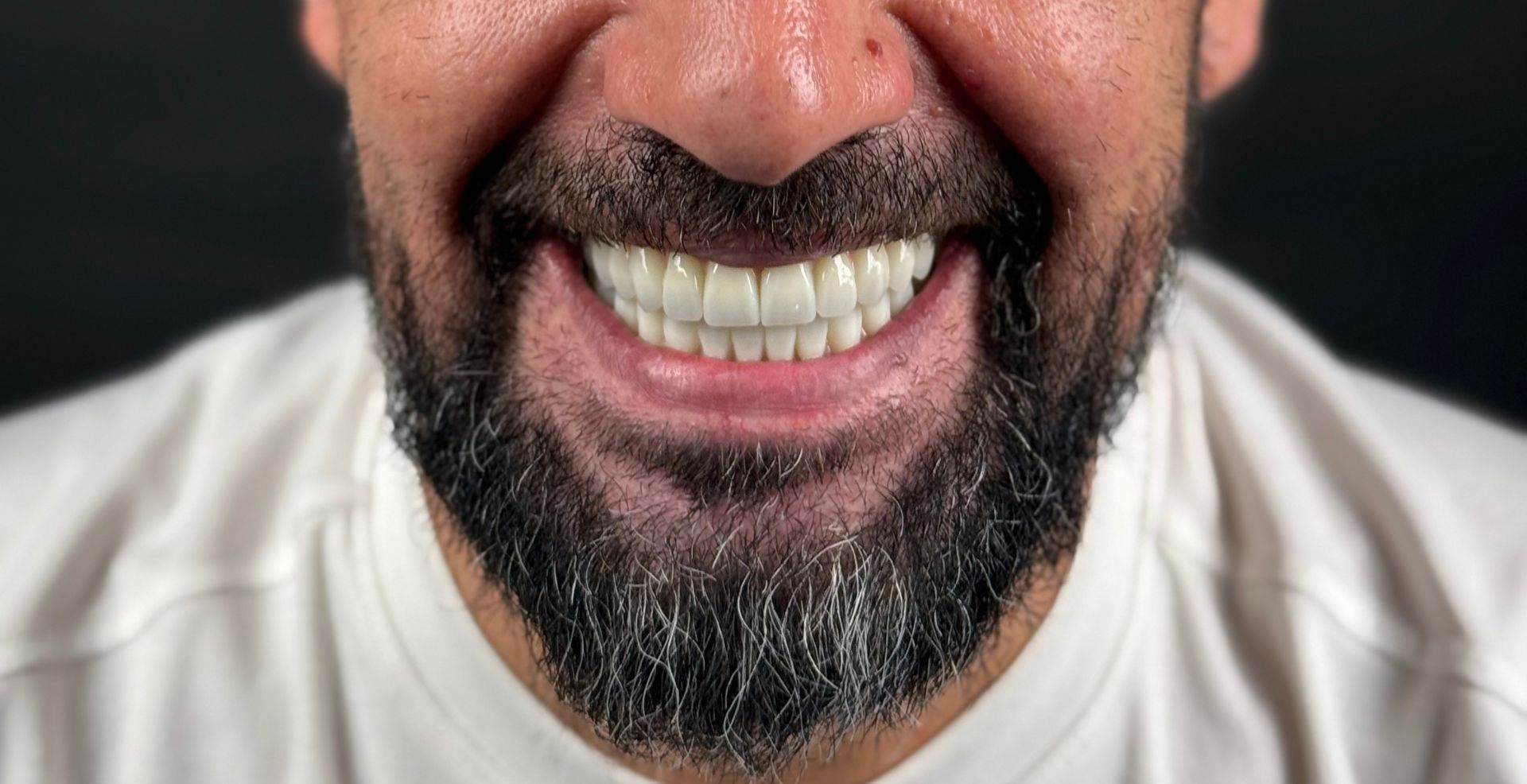 Caz cu atrofie osoasă rezolvat la Anghele Dental Iași, rezultat după tratament
