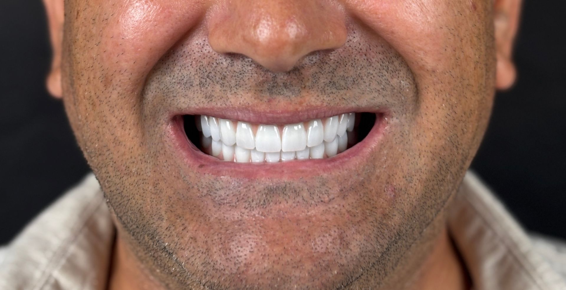 Rezultat tratament dental la Anghele Dental Iași