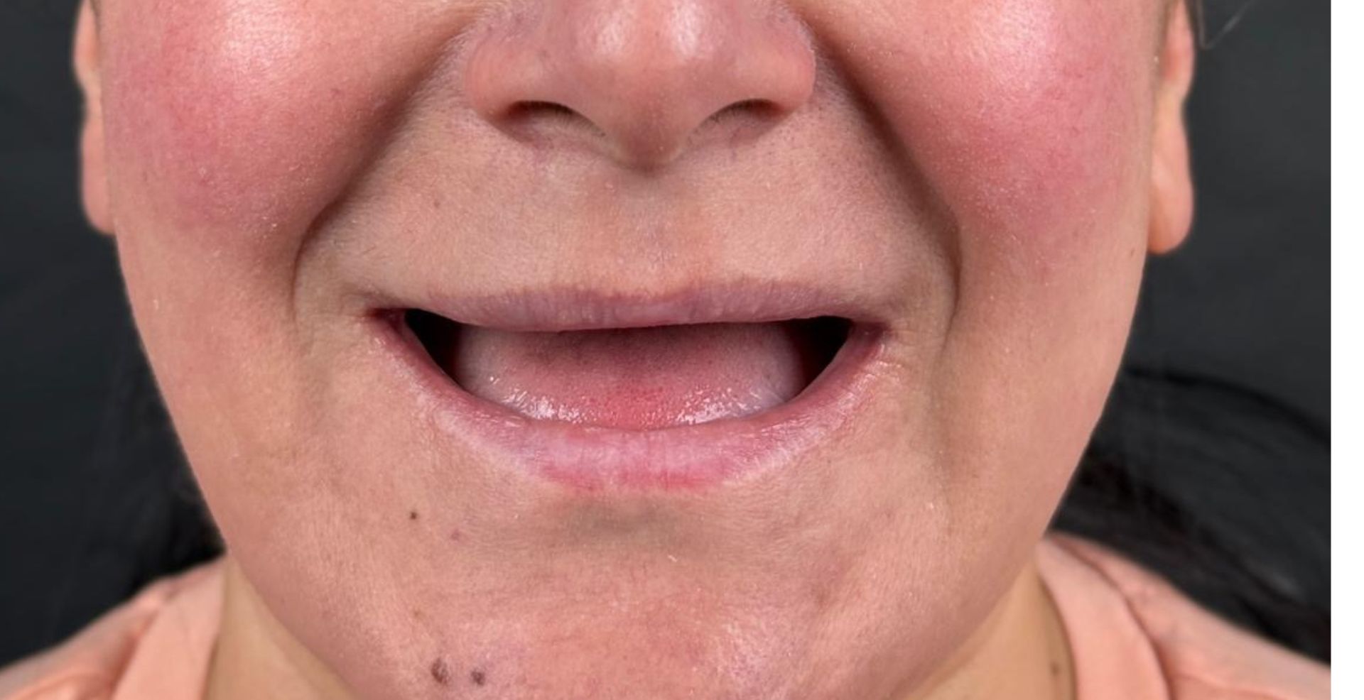 Reabilitare arcadă cu implanturi la Anghele Dental Iași, înainte de tratament