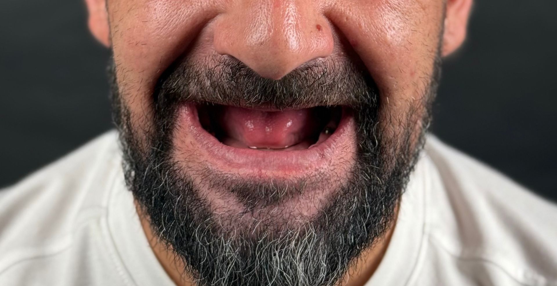 Caz cu atrofie osoasă la Anghele Dental Iași, înainte de tratament