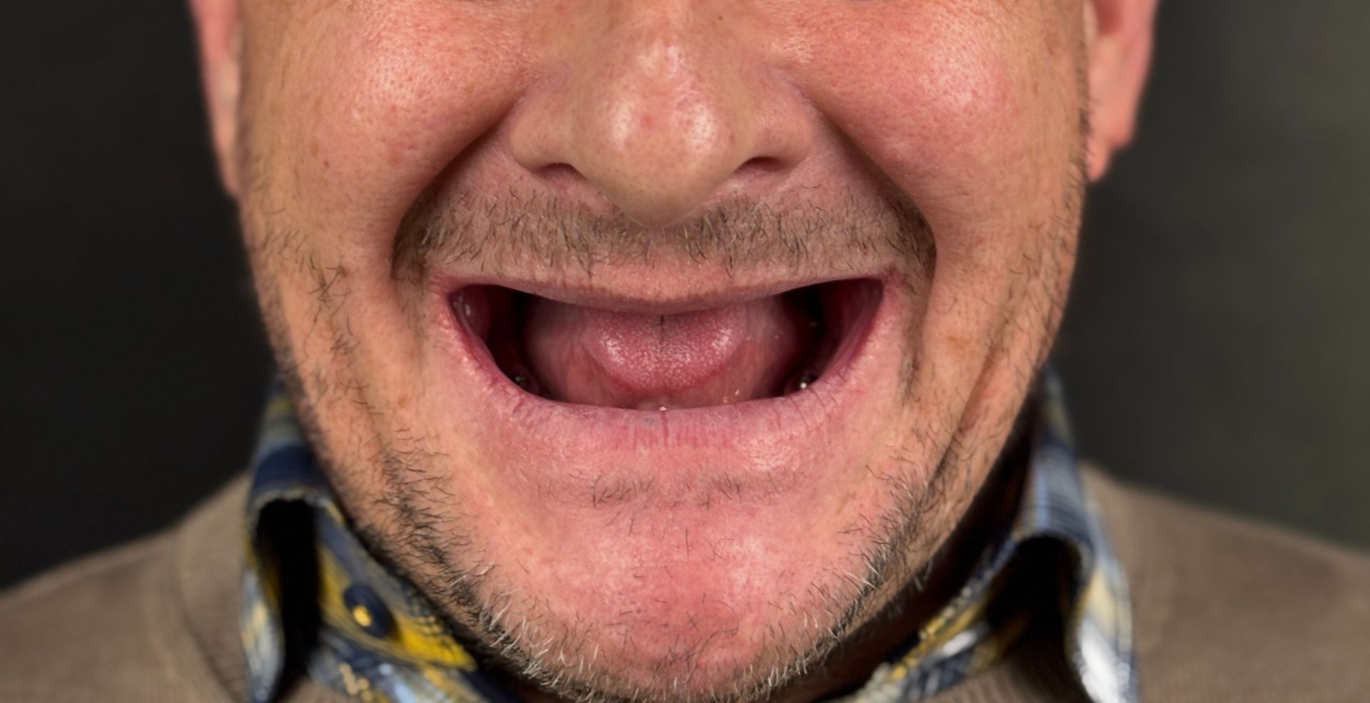 Estetică dentară Anghele Dental Iași, înainte de smile design