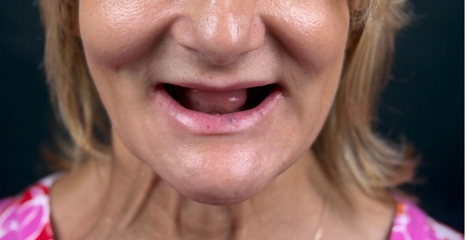 Reabilitare completă multidisciplinară Anghele Dental Iași, înainte