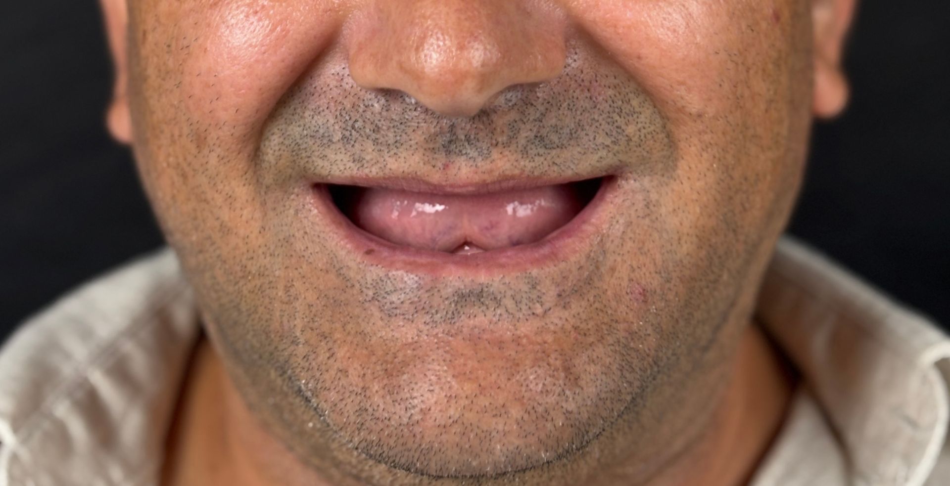 Stare inițială tratament dental la Anghele Dental Iași