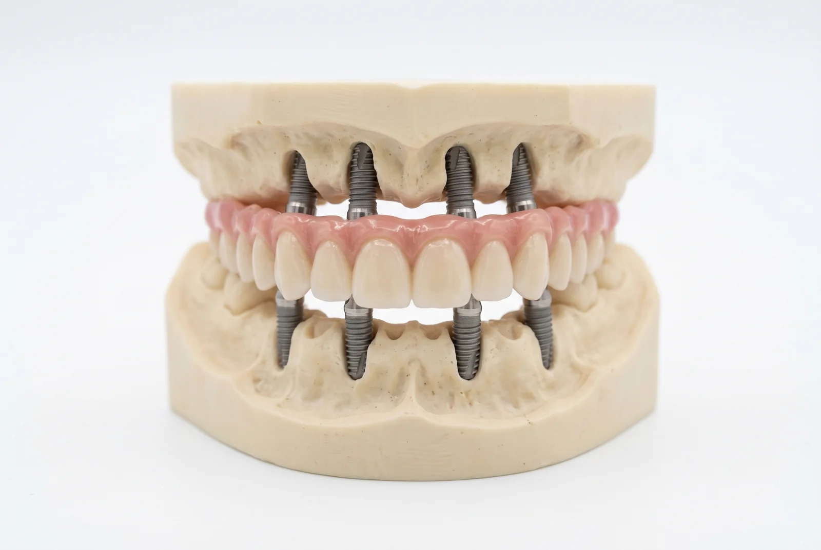 All on 6 pret romania - Costuri si beneficii in tratamentele dentare