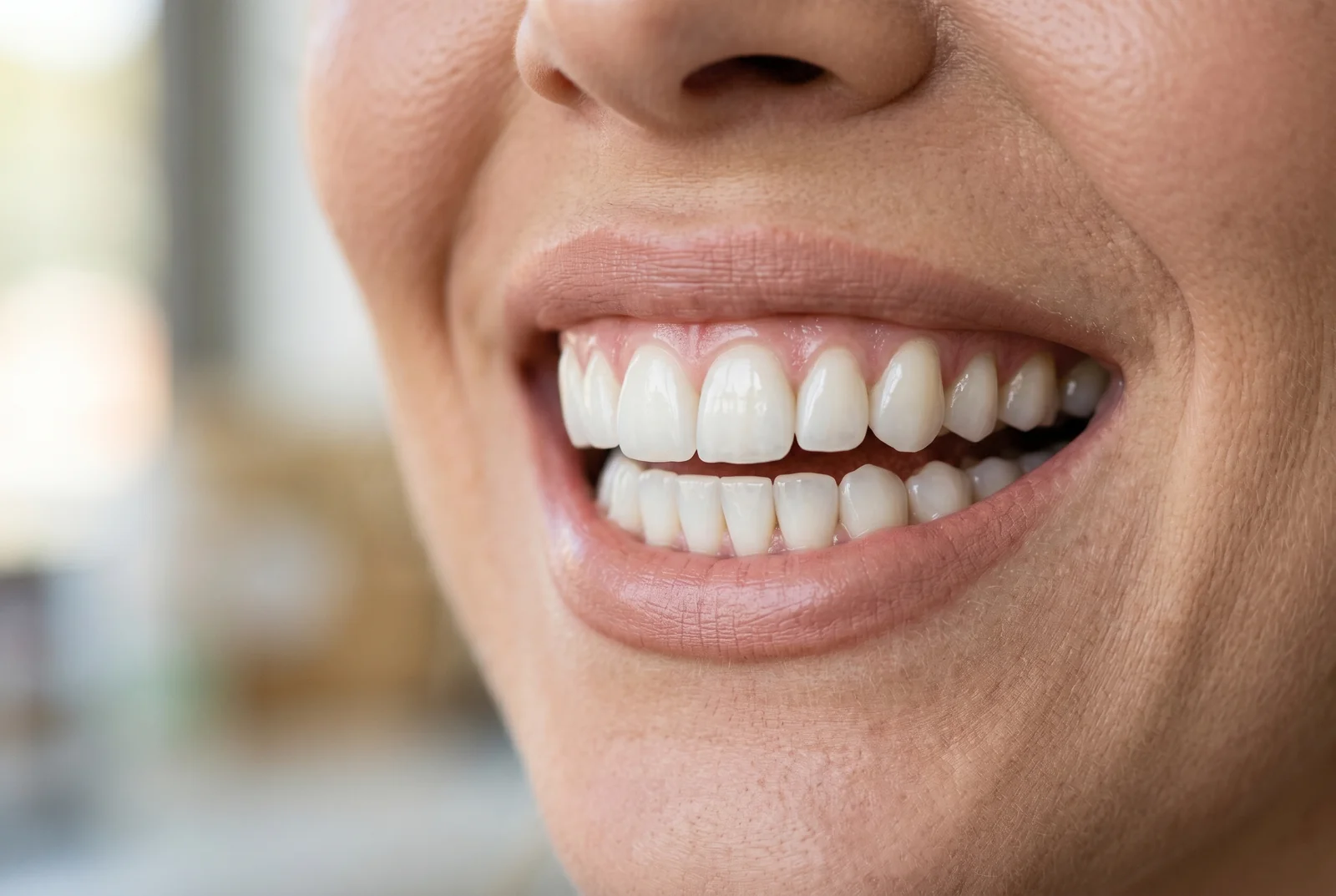Fatete dentare composite pret - Tot ce trebuie sa stii
