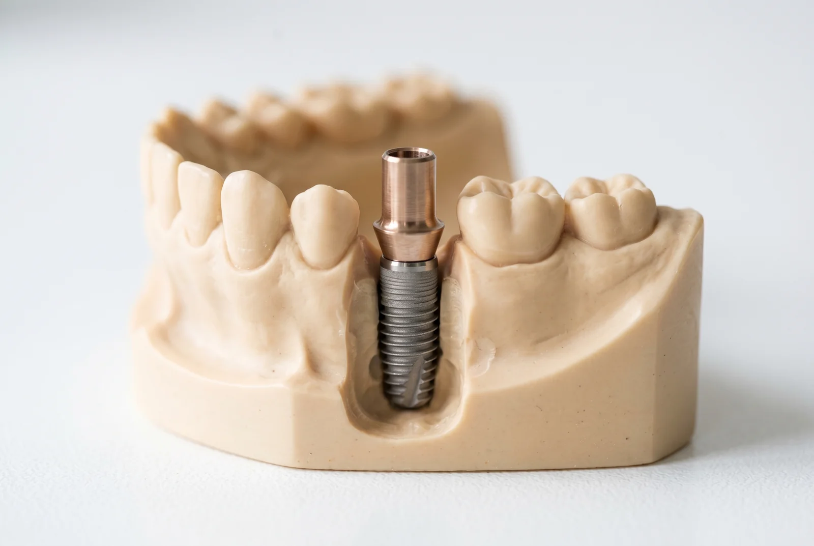 Implant dentar decontat casa de sanatate - Solutii accesibile pentru pacienti