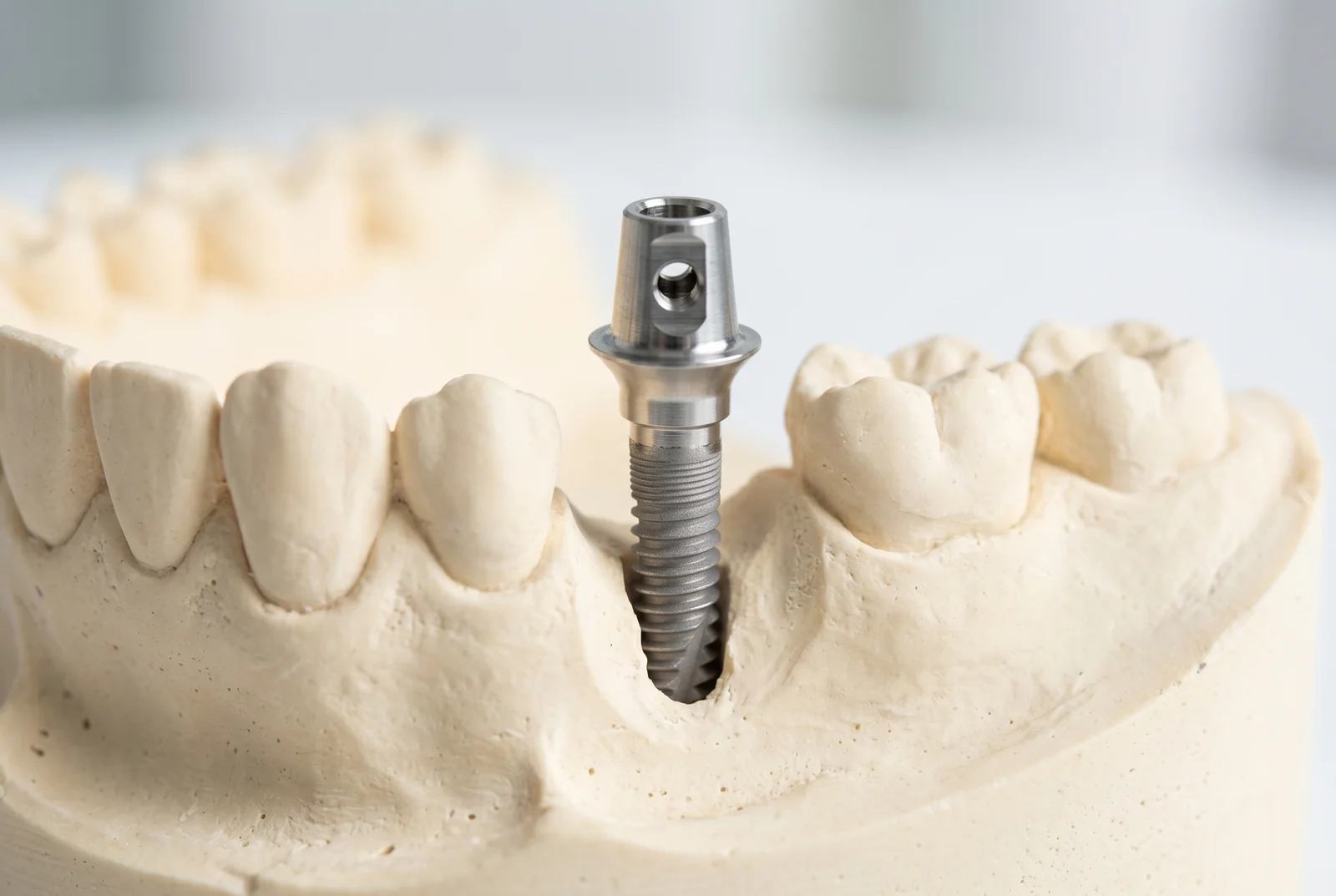 Implant dentar la batrani - Solutii pentru sanatatea dentara