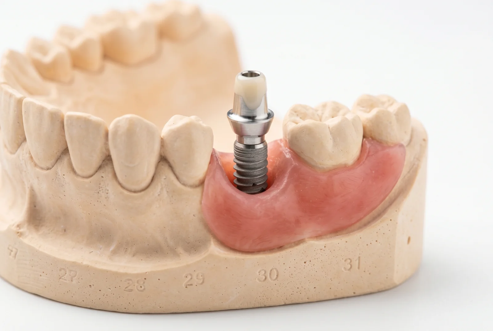 Implant dentar one day - Solutia rapida pentru zambetul tau