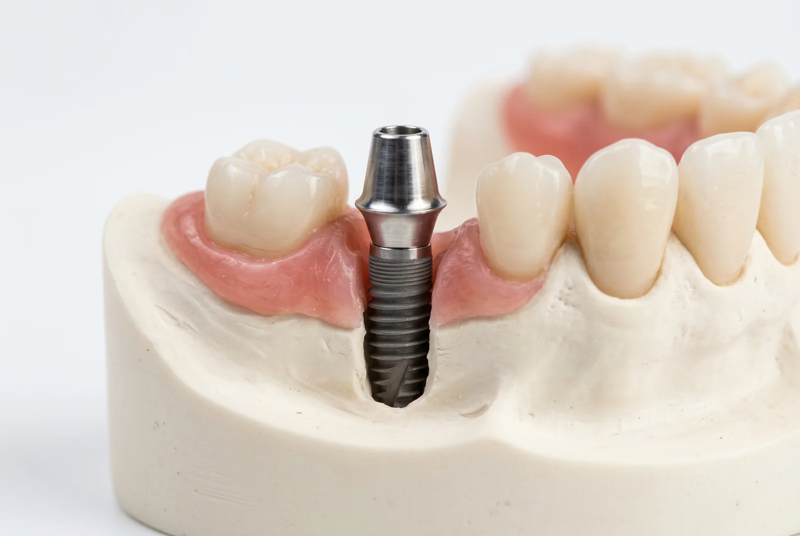 Rejecie implant dentar simptome - Informatii utile pacienti